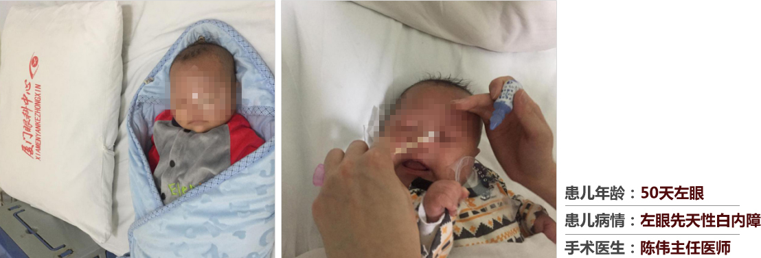 患兒年齡：50天左眼，患兒病情：左眼先天性白內(nèi)障，手術(shù)醫(yī)生：白內(nèi)障科陳偉主任醫(yī)師