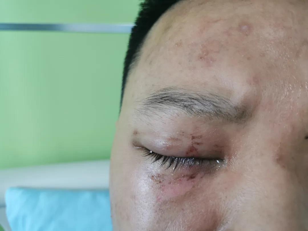 洗衣液進眼睛怎么辦