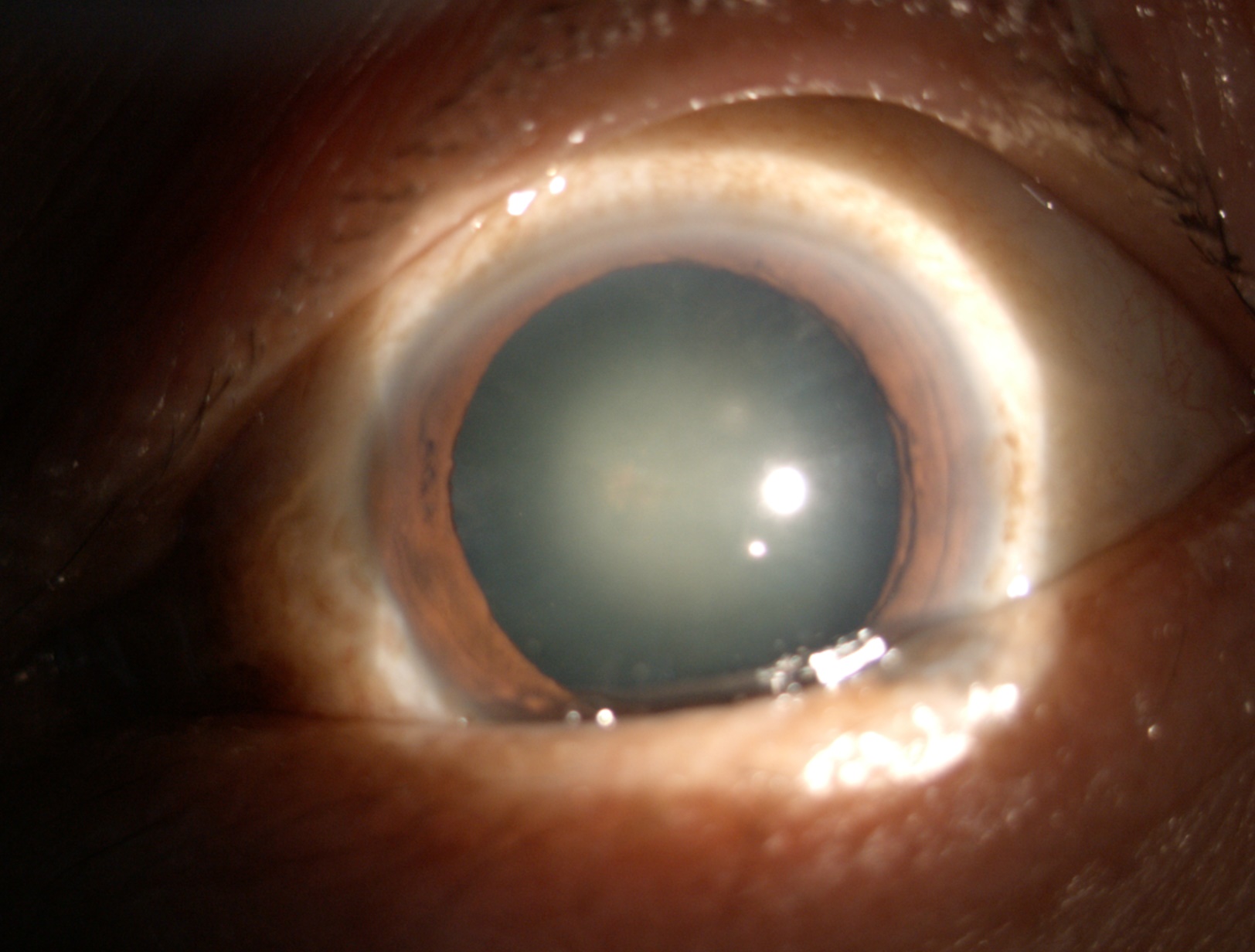 白內(nèi)障癥狀