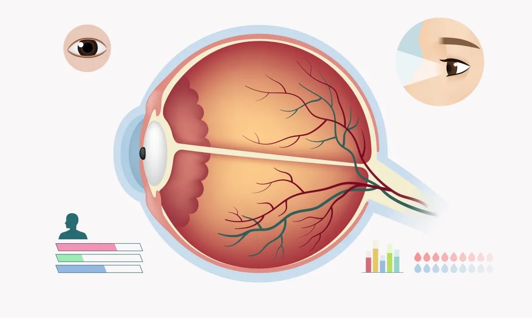 糖尿病視網(wǎng)膜病變預防