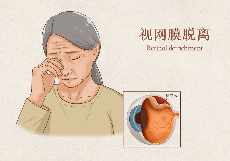 視網(wǎng)膜脫落能治好嗎