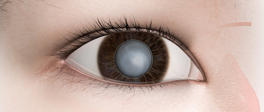 白內(nèi)障手術