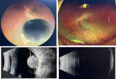 以為只是眼花，竟查出眼內(nèi)惡性腫瘤！50歲男子及時(shí)就醫(yī)后，獲“保眼”治療機(jī)會(huì)！