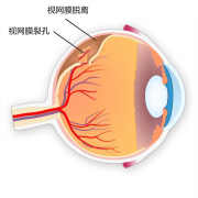 揉眼睛時(shí)出現(xiàn)閃光感是怎么回事？注意！可能是視網(wǎng)膜脫離！